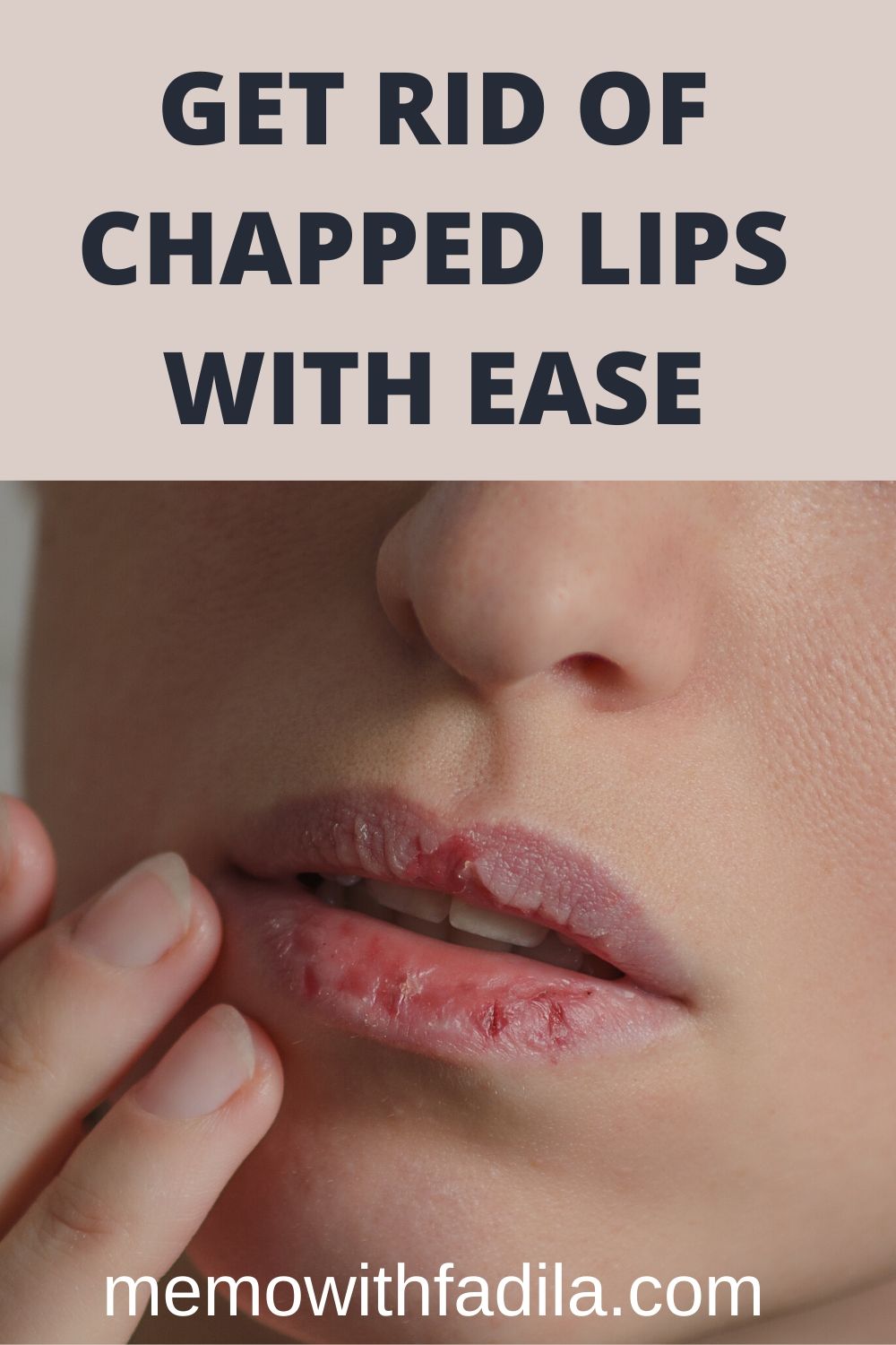 How To Get Rid Of Chapped Lips Asap