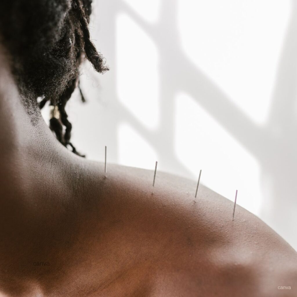 up close picture of acupuncture session. 